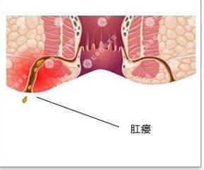 肛瘘最新治疗方法概述