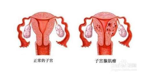 子宫腺肌症最新治疗进展与策略综述